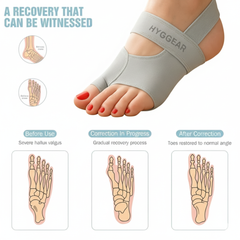 Corrector Higgear [Juanete del dedo gordo del pie, Hallux Valgus]